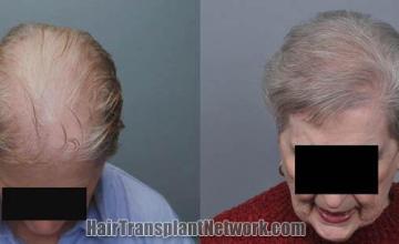 Hair restoration procedure before and after results