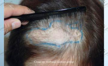 Female hair replacement surgery before and after images