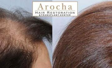 Female hair transplantation surgery before and after images