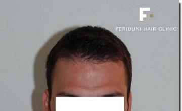 Hair restoration procedure results