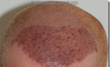 Hair restoration procedure results