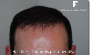 Hair restoration procedure results