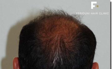 Hair restoration procedure results