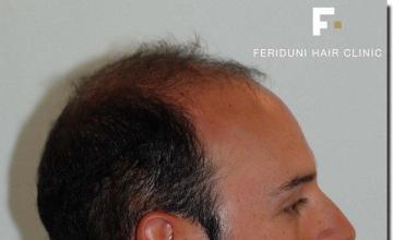 Hair restoration procedure results