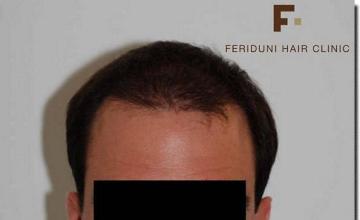 Hair restoration procedure results