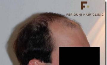 Hair restoration procedure results