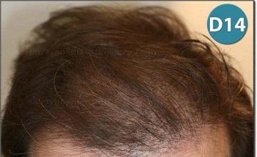 Hair restoration procedure results
