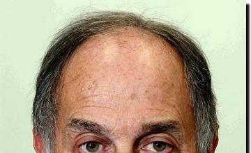 Hair restoration procedure results