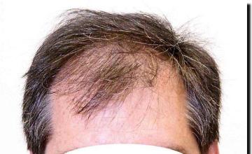 Hair restoration procedure results