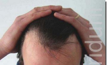 Hair restoration procedure results