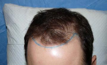 Frontal area before surgery
