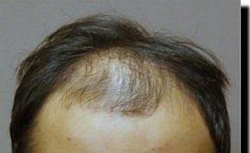 Hair restoration procedure results