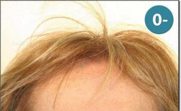Hair restoration procedure results