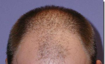 Hair restoration procedure results