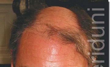 Hair restoration procedure results