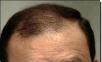 Before undergoing a hair transplant