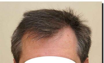 Hair restoration procedure results