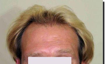 Hair restoration procedure results