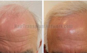 Frontal area before and after surgery 