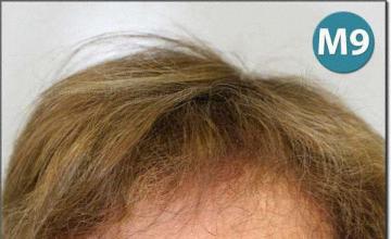 Hair restoration procedure results