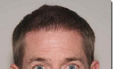 Hair restoration procedure results