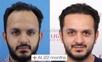 Frontal area before and after surgery 