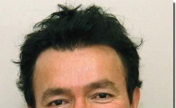 Hair restoration procedure results