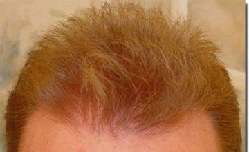 Hair restoration procedure results