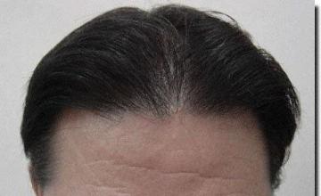 Hair restoration procedure results