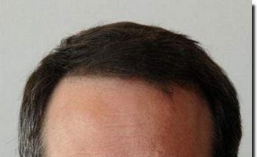 Hair restoration procedure results