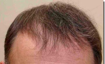 Hair restoration procedure results