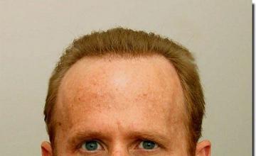 Hair restoration procedure results