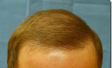 Hair restoration procedure results