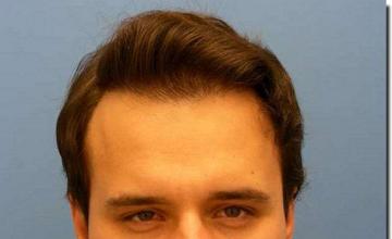 Hair restoration procedure results