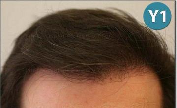 Hair restoration procedure results