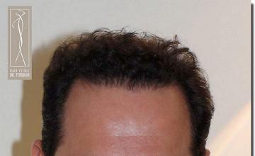 Hair restoration procedure results