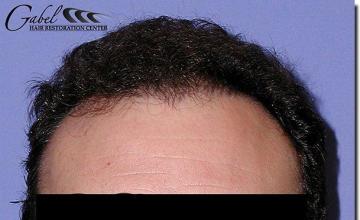 Hair restoration procedure results