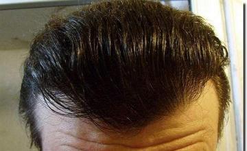 Hair restoration procedure results