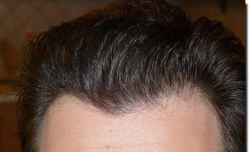 Hair restoration procedure results