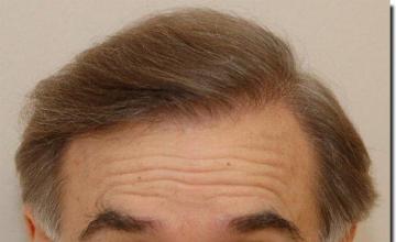 Hair restoration procedure results