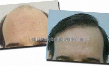 Hair restoration procedure results