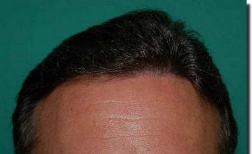 Hair restoration procedure results