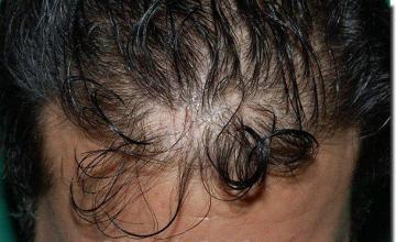 Hair restoration procedure results