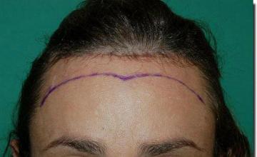 Hair restoration procedure results