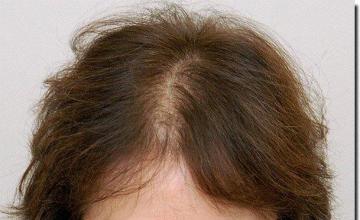 Hair restoration procedure results