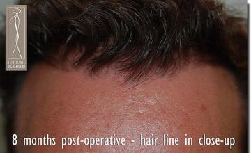 Hair restoration procedure results