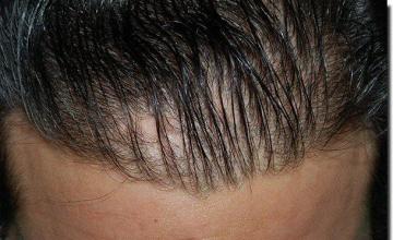 Hair restoration procedure results