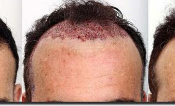 Hair restoration procedure before and after results