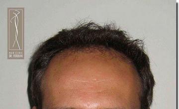 Hair restoration procedure results