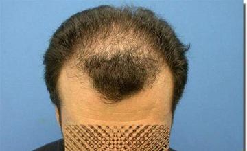 Hair restoration procedure results